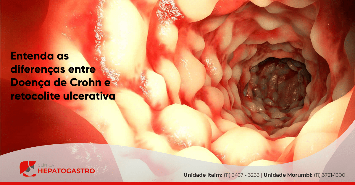 Entenda As Diferenças Entre Doença De Crohn E Retocolite Ulcerativa