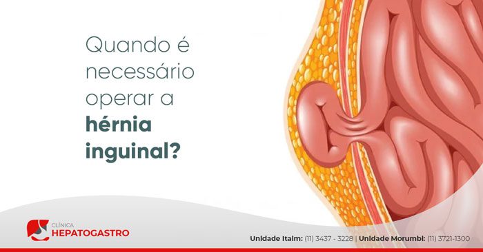 Quando é Necessário Operar A Hérnia Inguinal? - Clínica Hepatogastro