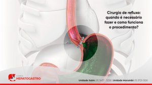 Cirurgia De Refluxo: Quando é Necessário Fazer E Como Funciona O ...