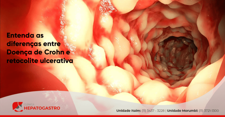 Entenda As Diferenças Entre Doença De Crohn E Retocolite Ulcerativa Clínica Hepatogastro