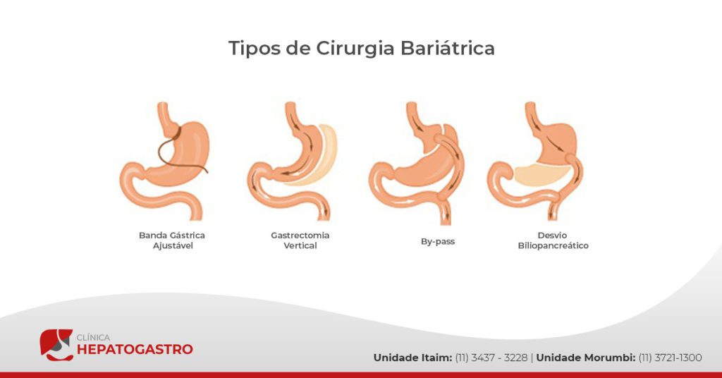 Tipos De Cirurgia Bariátrica | Hepatogastro