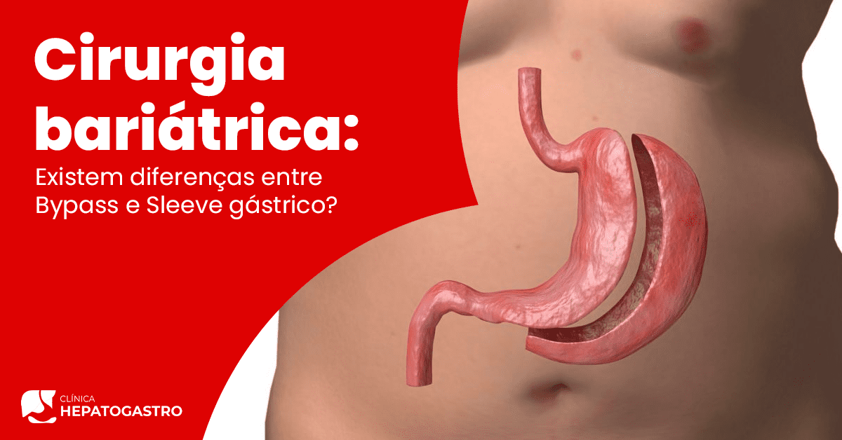 Cirurgia Bariátrica Existem Diferenças Entre Bypass E Sleeve Gástrico Clínica Hepatogastro 