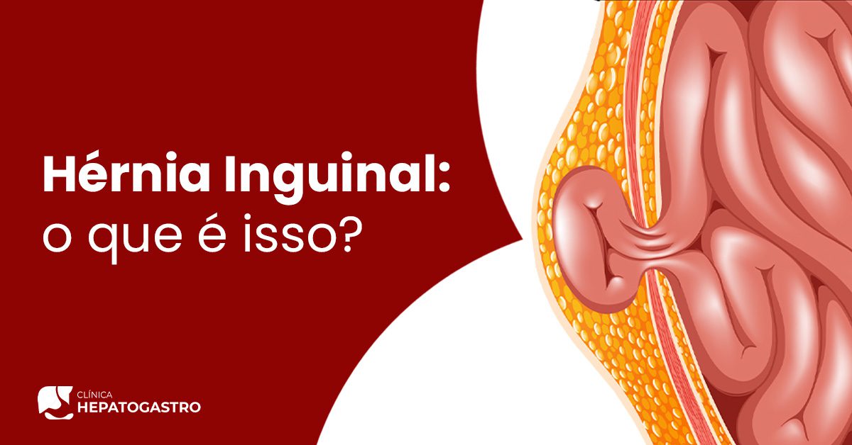 Hérnia Inguinal – O Urologista pode me avaliar? – Clínica Big Doctor