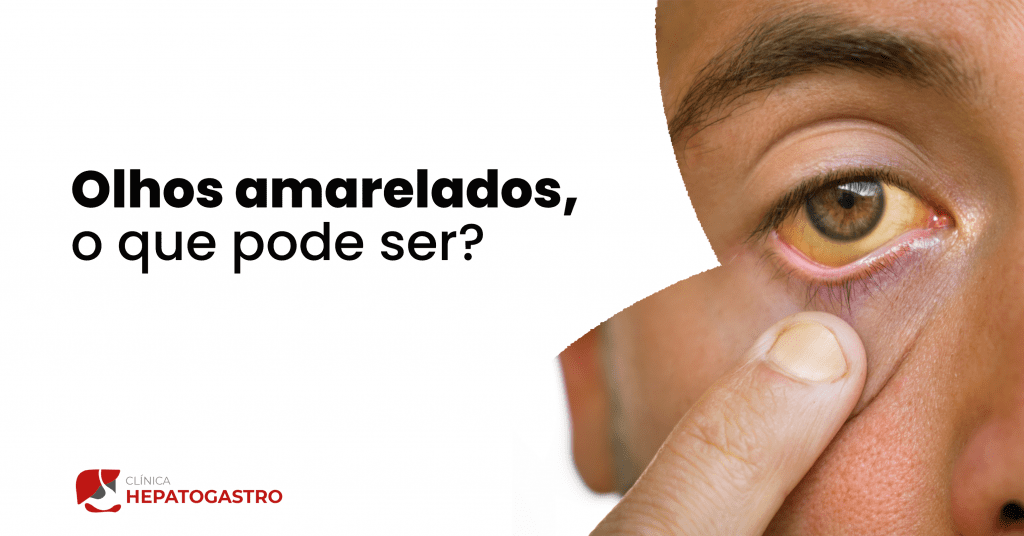 Olhos amarelados: 10 principais causas, sintomas e o que fazer