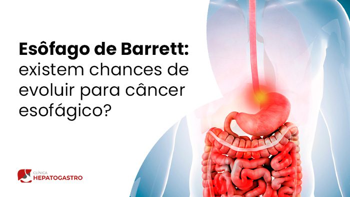 esofago de barrett existem chances de evoluir para cancer esofagiconbsp blog
