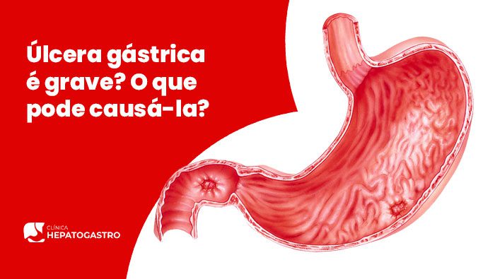 Ulcera Gastrica E Grave O Que Pode Causa La Hepatogastro Bg