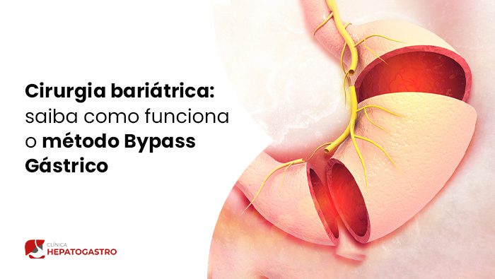 Cirurgia Bariatrica Saiba Como Funciona O Metodo Bypass Gastrico Blog