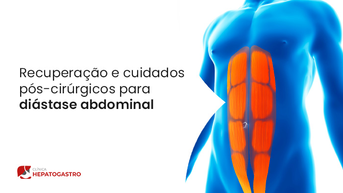 A Imagem Ilustra Uma Diastase Abdominal