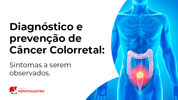 Ilustração Médica De Um Corpo Humano Destacando O Intestino Grosso E O Reto, Com Uma Área Vermelha Indicando Inflamação Ou Doença Colorretal, Usada Para Fins Educativos Sobre Câncer Colorretal.