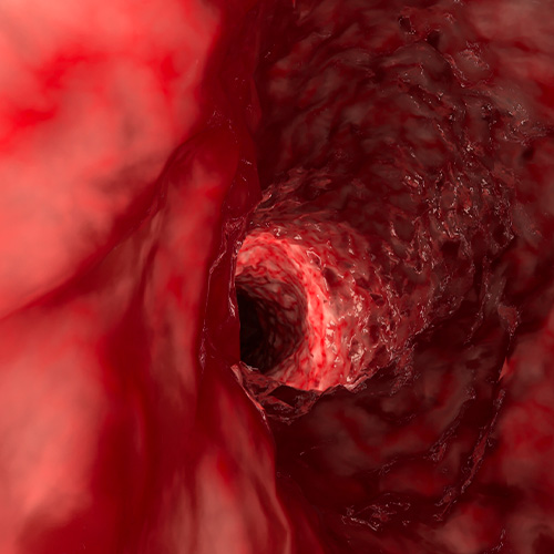 A complexidade da Doença de Crohn: avanços no diagnóstico e tratamento