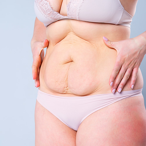 Diástase abdominal após a gravidez: o que é e como tratar?