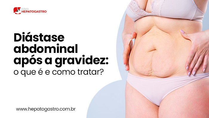 Mulher mostra a região do abdômen com flacidez e possível diástase, evidenciando alterações pós-gestação.