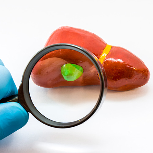 Recuperação após a colecistectomia: o que esperar do pós-operatório?