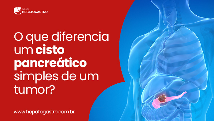 O Que Diferencia Um Cisto Pancreático Simples De Um Tumor? 1 Modelo Anatômico Do Pâncreas Sendo Segurado Por Mãos, Mostrando Estruturas Internas E Um Cisto Pancreático Em Destaque.