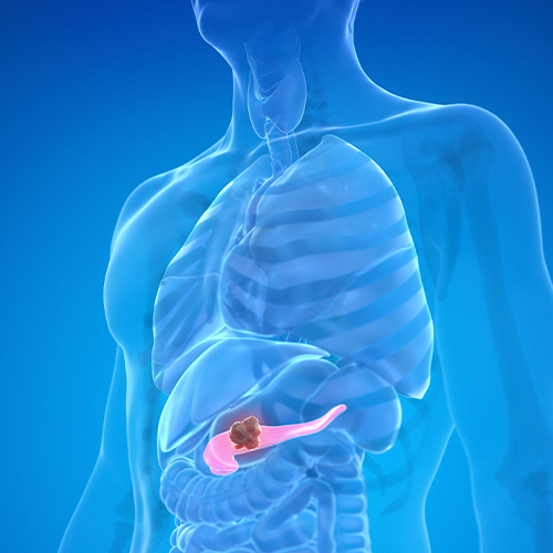 Modelo anatômico do pâncreas sendo segurado por mãos, mostrando estruturas internas e um cisto pancreático em destaque.