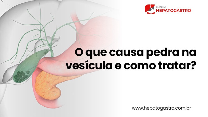 O Que Causa Pedra Na Vesícula E Como Tratar? 1 Ilustração Do Sistema Biliar Mostrando A Vesícula Com Múltiplas Pedras Formadas No Interior, Próxima Ao Fígado, Estômago E Pâncreas.