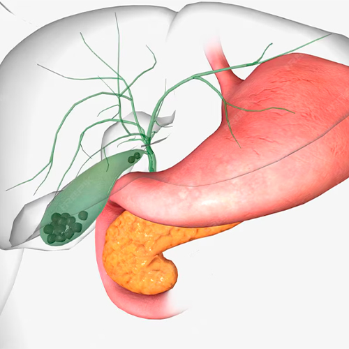 Ilustração do sistema biliar mostrando a vesícula com múltiplas pedras formadas no interior, próxima ao fígado, estômago e pâncreas.
