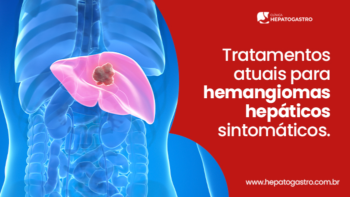 Tratamentos Atuais Para Hemangiomas Hepáticos Sintomáticos 1 Ilustração Anatômica Do Abdômen Com O Fígado Destacado E Lesão Visível, Representando Hemangioma Hepático.
