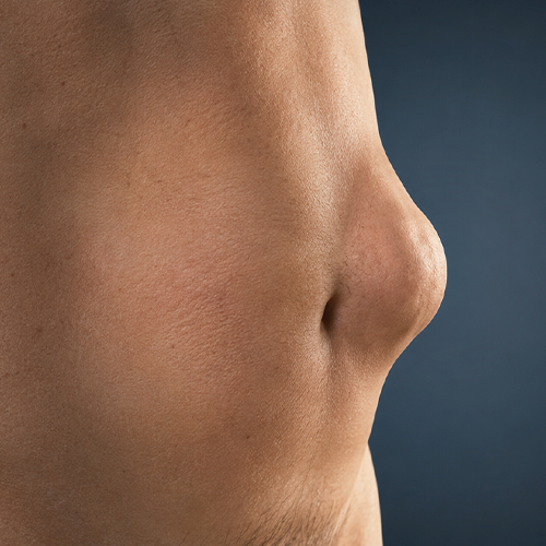 Close-up da região da virilha e parte inferior do abdômen de uma pessoa, mostrando uma saliência evidente na área inguinal.