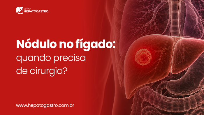 Nódulo No Fígado: Quando Precisa De Cirurgia? 1 Ilustração Anatômica Do Fígado Com Nódulo Em Destaque, Representando Lesão Hepática E Avaliação Para Possível Tratamento Cirúrgico.