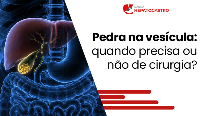 Pedra Na Vesícula: Quando Precisa Ou Não De Cirurgia? 1 Ilustração Anatômica Do Sistema Digestivo Com Fígado E Vesícula Biliar Em Destaque, Evidenciando Cálculos Biliares Na Vesícula.