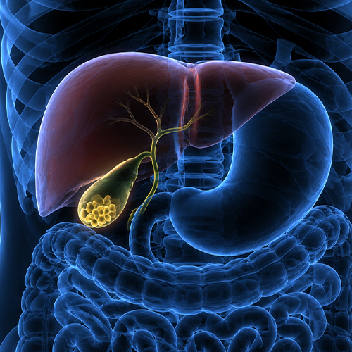 Ilustração anatômica do sistema digestivo com fígado e vesícula biliar em destaque, evidenciando cálculos biliares na vesícula.