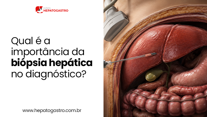 Qual É A Importância Da Biópsia Hepática No Diagnóstico? 1 Qual É A Importância Da Biópsia Hepática No Diagnóstico? | Hepatogastro