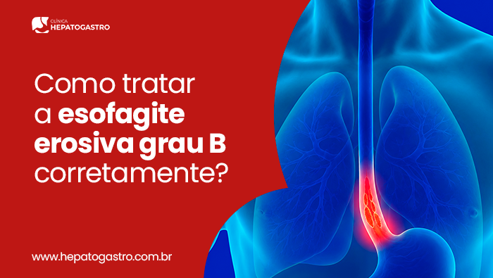 Como Tratar A Esofagite Erosiva Grau B Corretamente? 1 Arte Sobre Tratamento Da Esofagite Erosiva Grau B